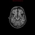 Cerebral and orbital tuberculomas (Radiopaedia 13308-13311 Axial T1 9).jpg