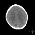 Cerebral contusion (Radiopaedia 48869-53911 Axial non-contrast 13).jpg