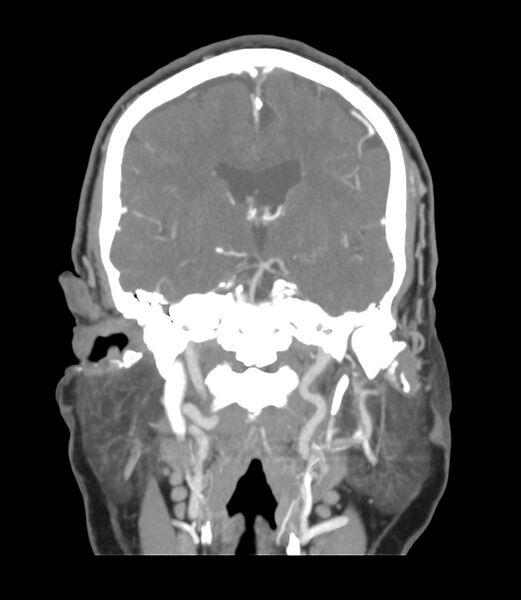 File:Cerebral dural venous sinus thrombosis (Radiopaedia 86514-102576 B 32).jpg