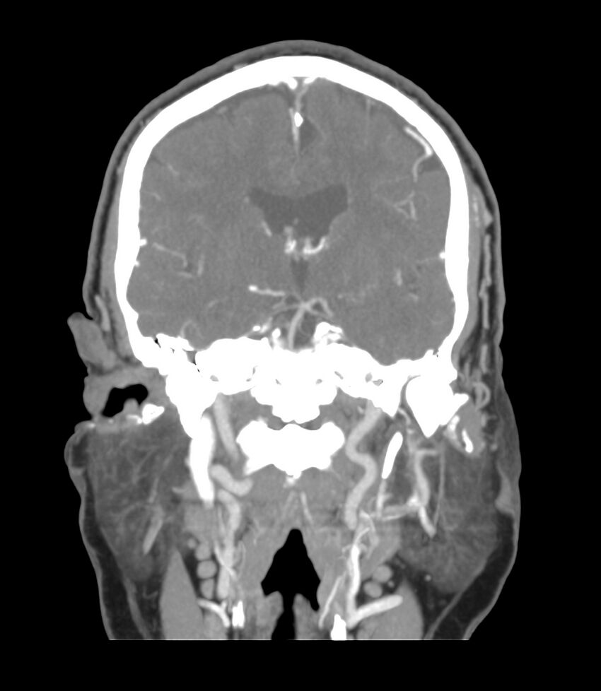 Cerebral dural venous sinus thrombosis (Radiopaedia 86514-102576 B 32).jpg