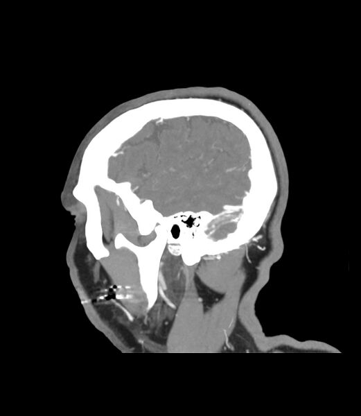 File:Cerebral dural venous sinus thrombosis (Radiopaedia 86514-102576 C 52).jpg