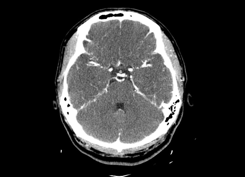 Cerebral edema (Radiopaedia 82519-96661 B 40).jpg