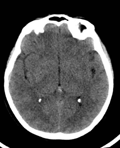 File:Cerebral edema due to severe hyponatremia (Radiopaedia 89826-106938 Axial non-contrast 50).jpg