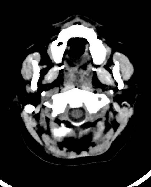 File:Cerebral edema due to severe hyponatremia (Radiopaedia 89826-106938 Axial non-contrast 7).jpg