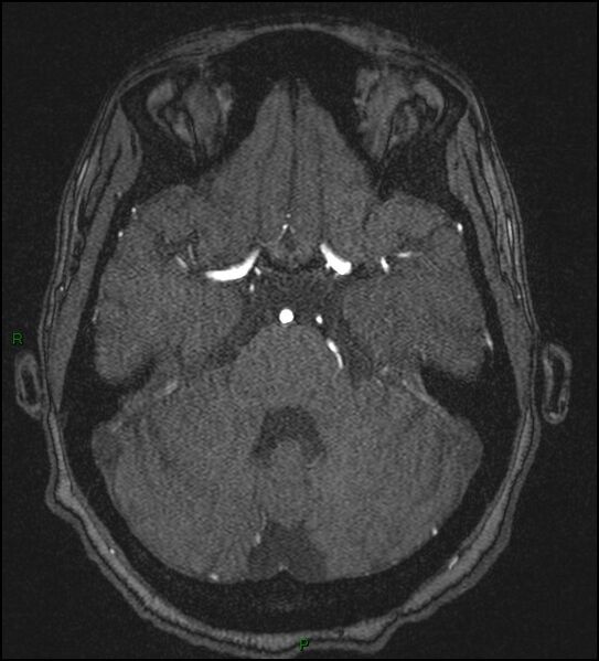 File:Cerebral fat embolism (Radiopaedia 35022-36525 Axial TOF 61).jpg