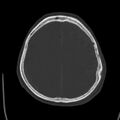 Cerebral hemorrhagic contusions (Radiopaedia 23145-23188 Axial bone window 43).jpg