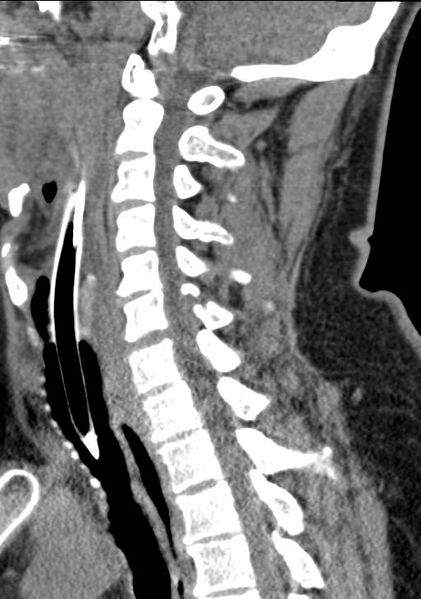 File:Cerebral hemorrhagic contusions and cervical spine fractures (Radiopaedia 32865-33841 G 54).jpg
