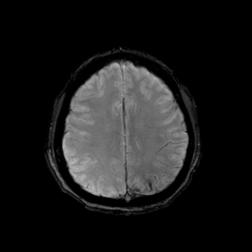 Cerebral paragonimiasis (Radiopaedia 73473-84238 Axial SWI 49).jpg