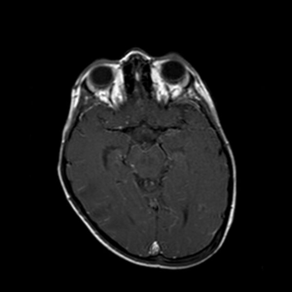 File:Cerebral tuberculoma (Radiopaedia 41152-43932 Axial T1 C+ 9).jpg