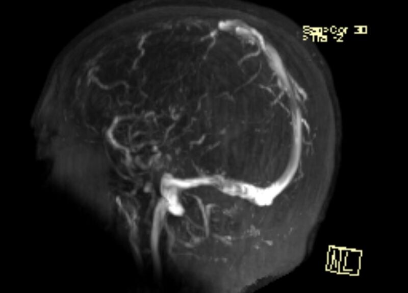 File:Cerebral venous infarct (Radiopaedia 53627-59723 3D MRV 3).jpg