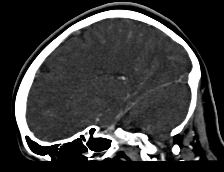 File:Cerebral venous sinus thrombosis (Radiopaedia 59224-66646 Sagittal C+ delayed 35).jpg