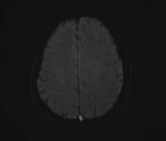 File:Cerebral venous thrombosis (Radiopaedia 71207-81504 Axial DWI 14).jpg