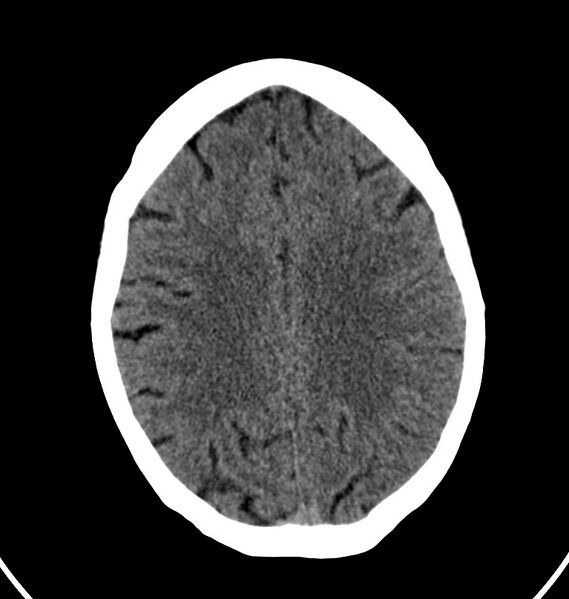 File:Cerebral venous thrombosis - CT only (Radiopaedia 41031-43778 Axial non-contrast 25).jpg