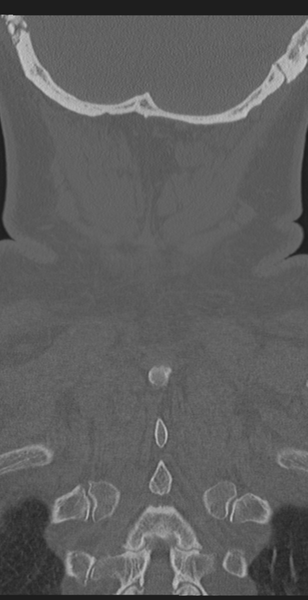 File:Cervical canal stenosis due to ossification of the posterior longitudinal ligament (Radiopaedia 47260-51823 Coronal bone window 60).png