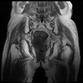 Cervical carcinoma (Radiopaedia 78847-91705 Coronal T1 11).jpg