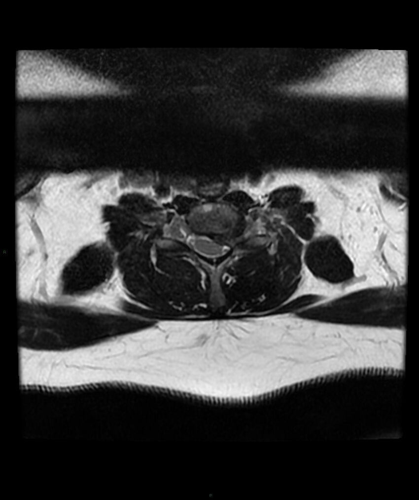 Cervical disc prolapse (Radiopaedia 80258-93598 Axial T2 54).jpg