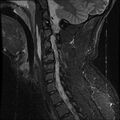 Cervical flexion teardrop fracture with cord hemorrhage (Radiopaedia 32497-33455 Sagittal STIR 6).jpg