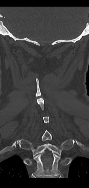 File:Cervical spine fracture - chalk stick (Radiopaedia 39116-41323 Coronal bone window 41).png