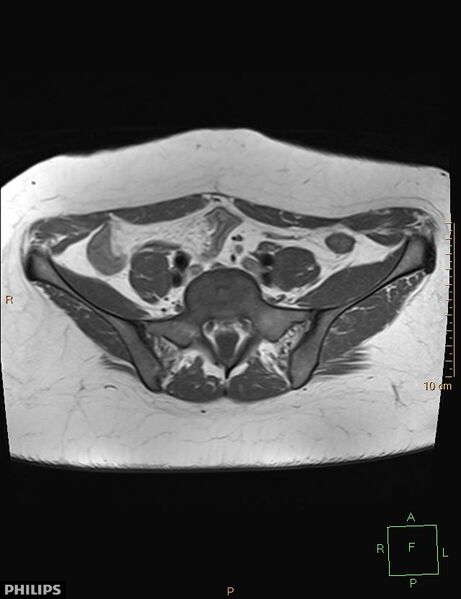 File:Cesarian scar endometriosis (Radiopaedia 68495-78066 Axial T1 1).jpg