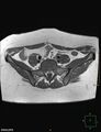 Cesarian scar endometriosis (Radiopaedia 68495-78066 Axial T1 1).jpg