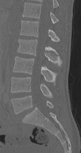 File:Chance fracture (Radiopaedia 40360-42912 Sagittal bone window 51).png