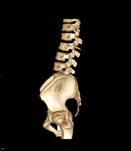 File:Chance fracture with duodenal and pancreatic lacerations (Radiopaedia 43477-50042 Sagittal 3D 1).jpg