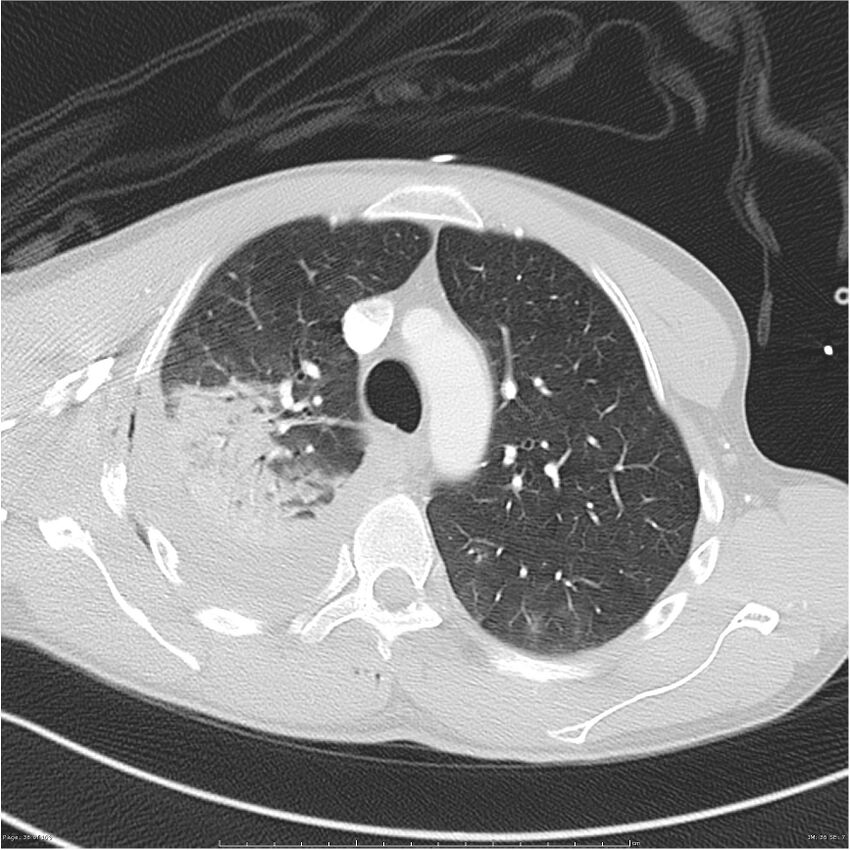 Chest and abdomen multi-trauma (Radiopaedia 26294-26425 lung window 36).jpg