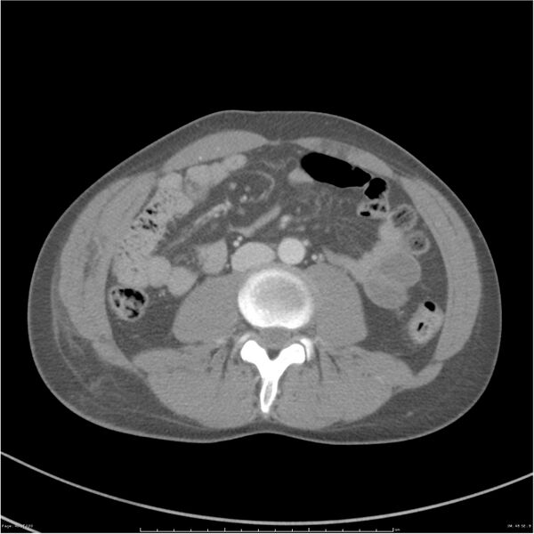 File:Chest and abdomen multi-trauma (Radiopaedia 26294-26426 bone window 48).jpg