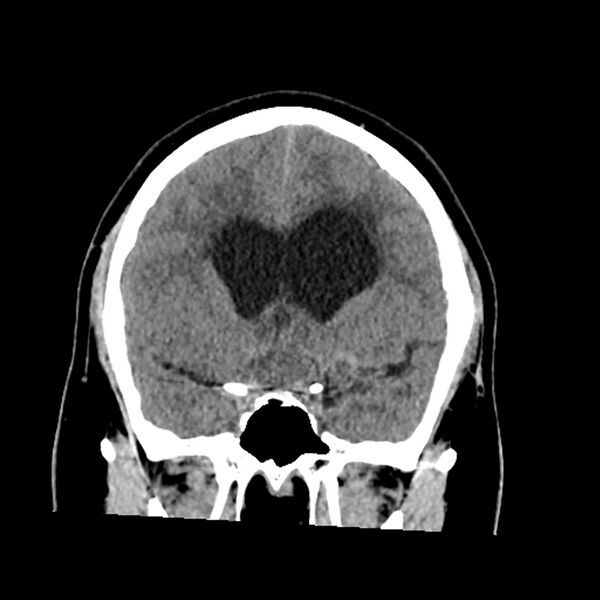 File:Chiasmatic-hypothalamic juvenile pilocytic astrocytoma (Radiopaedia 78533-91237 Coronal non-contrast 28).jpg