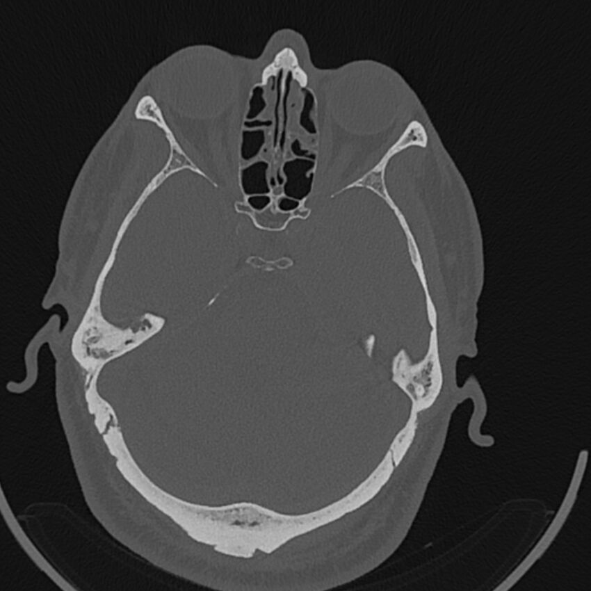 Cholesteatoma (Radiopaedia 68176-77673 Axial bone window 72).jpg