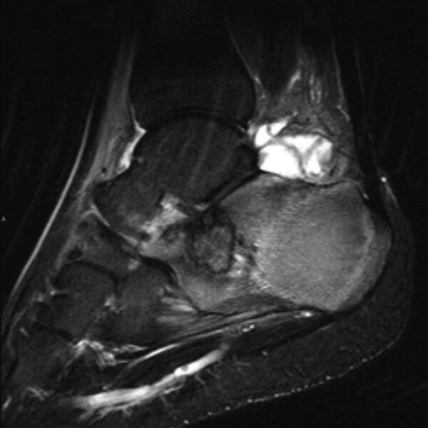 File:Chondroblastoma- calcaneum (Radiopaedia 10337-10859 Sagittal T2 fat sat 2).jpg