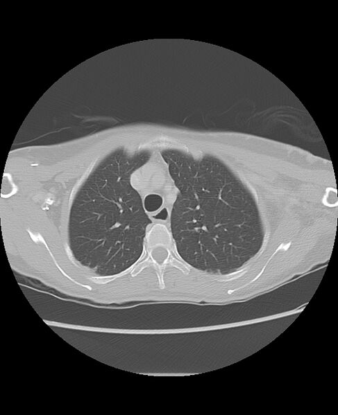 File:Chondrosarcoma (Radiopaedia 79427-92532 Axial lung window 14).jpg