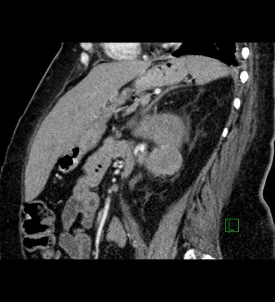 File:Chromophobe renal cell carcinoma (Radiopaedia 84239-99519 D 48).jpg