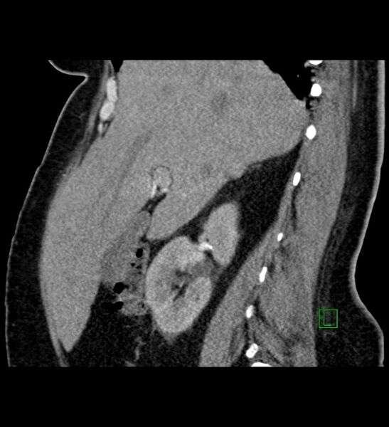 File:Chromophobe renal cell carcinoma (Radiopaedia 84239-99519 D 77).jpg