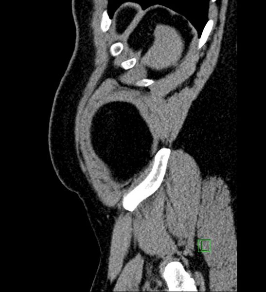 File:Chromophobe renal cell carcinoma (Radiopaedia 84286-99573 C 7).jpg