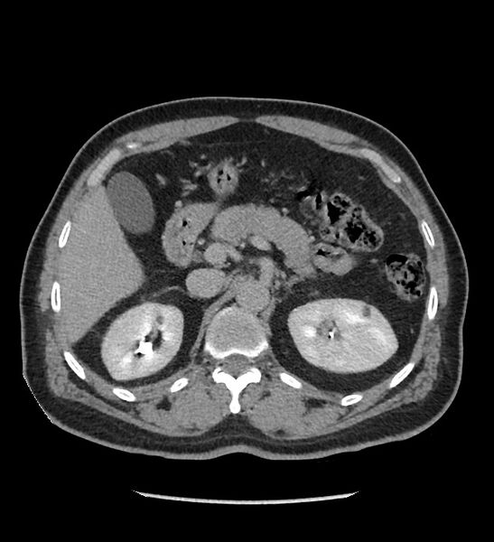 File:Chromophobe renal cell carcinoma (Radiopaedia 86879-103083 D 45).jpg