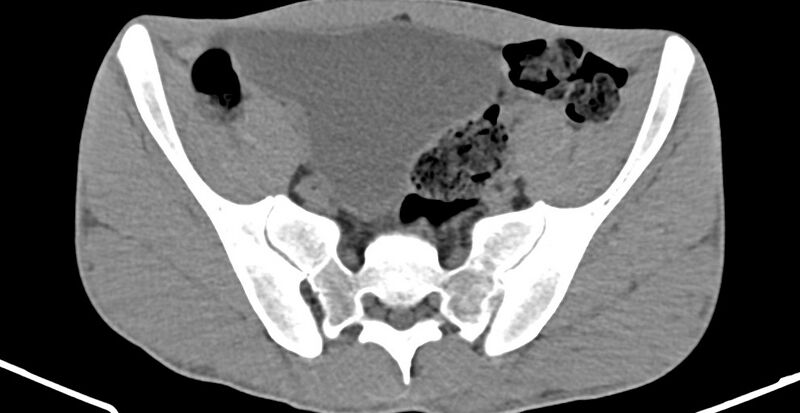 File:Chronic osteomyelitis (with sequestrum) (Radiopaedia 74813-85822 D 10).jpg