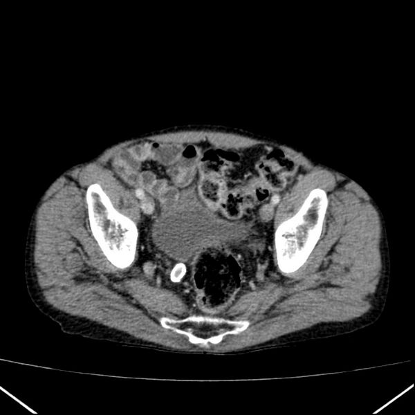 File:Chronic pancreatitis (Radiopaedia 23132-23172 B 62).jpg