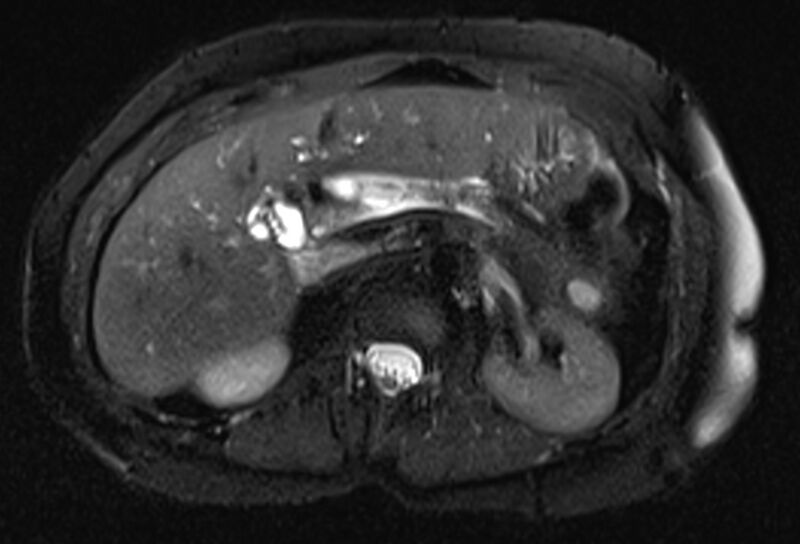 File:Chronic pancreatitis - pancreatic duct calculi (Radiopaedia 71818-82250 Axial T2 fat sat 24).jpg