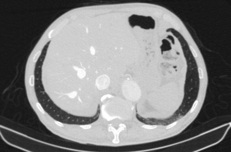 File:Chronic pulmonary embolism (Radiopaedia 91241-108843 Axial lung window 86).jpg