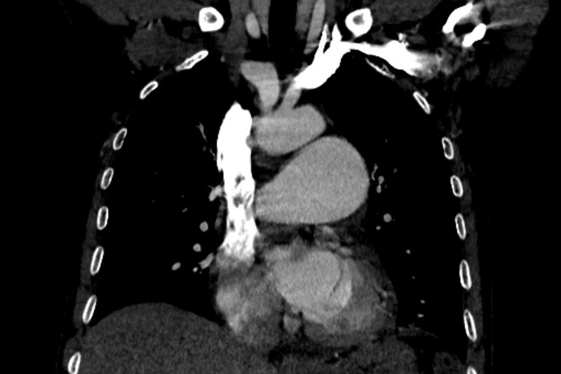 File:Chronic pulmonary embolism with bubbly consolidation (Radiopaedia 91248-108850 B 63).jpg