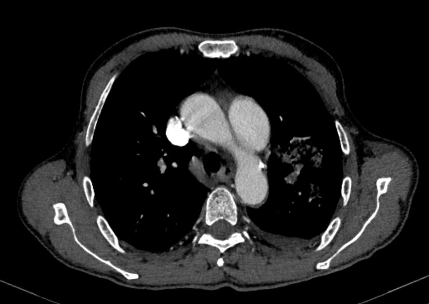 Chronic pulmonary embolism with bubbly consolidation (Radiopaedia 91248-108850 C+ arterial phase 44).jpg