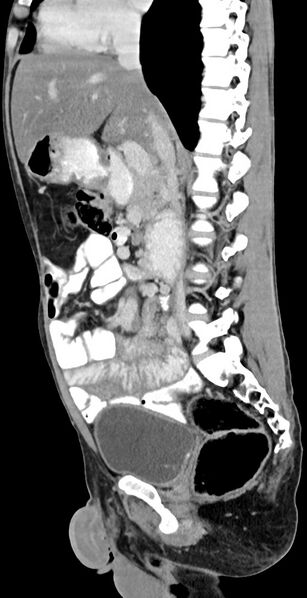 File:Chronic small bowel volvulus (Radiopaedia 75224-86322 C 83).jpg