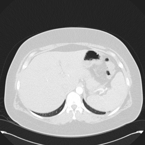 File:Chronic thromboembolic pulmonary hypertension (CTEPH) (Radiopaedia 74597-85531 Axial lung window 52).jpg