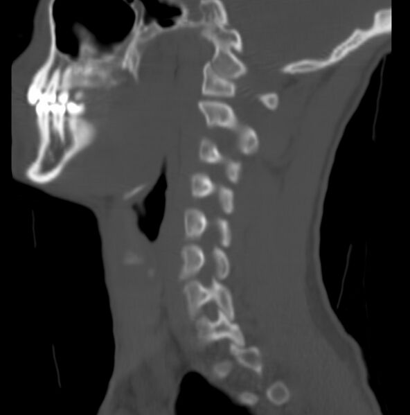 File:Cleft of the posterior arch of C1 mimicking fracture (Radiopaedia 40201-42721 Sagittal bone window 13).jpg