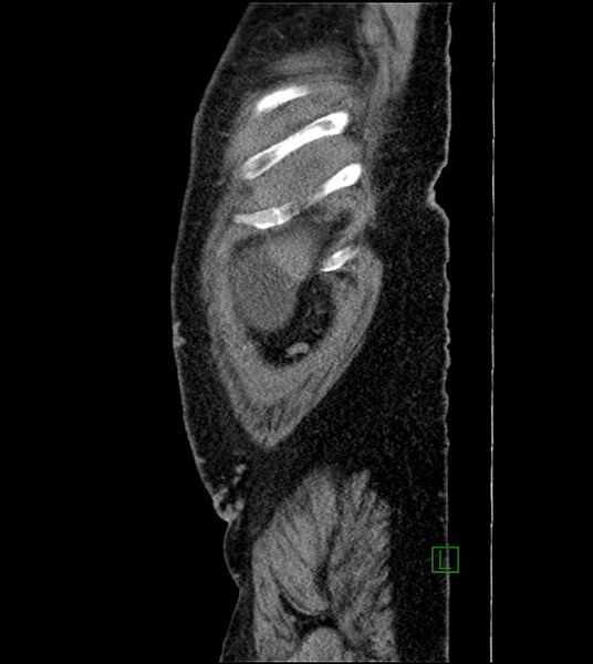 File:Closed-loop small bowel obstruction-internal hernia (Radiopaedia 78439-91096 C 131).jpg