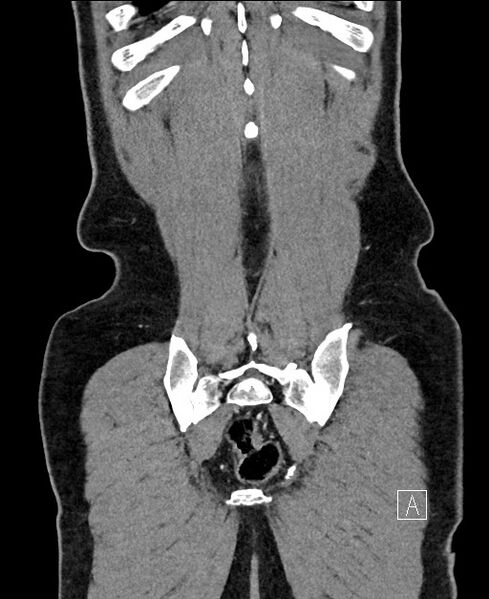 File:Closed loop small bowel obstruction - internal hernia (Radiopaedia 57806-64778 A 110).jpg
