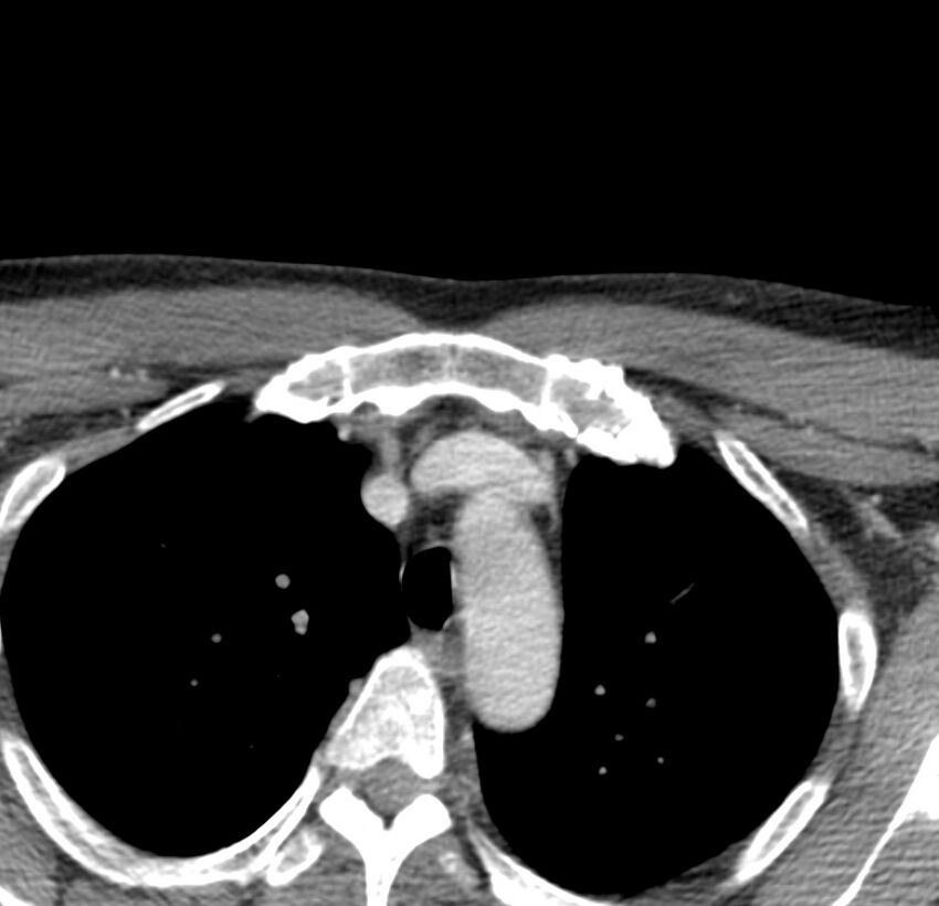 Colloid cyst of thyroid (Radiopaedia 22897-22923 Axial C+ delayed 86).jpg
