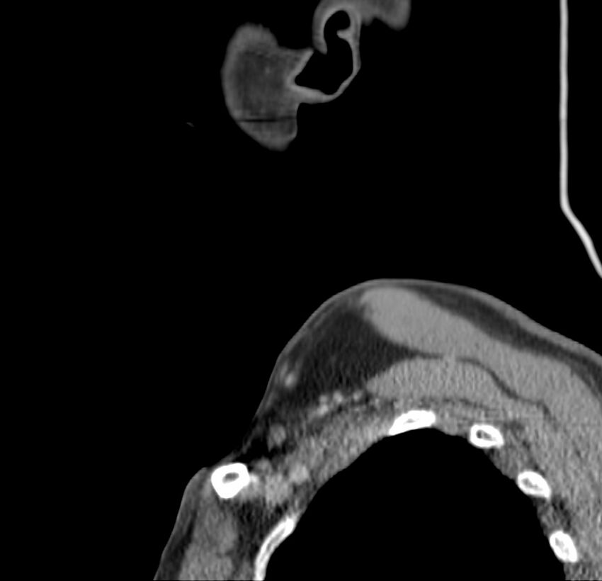 Colloid cyst of thyroid (Radiopaedia 22897-22923 Sagittal C+ delayed 5).jpg