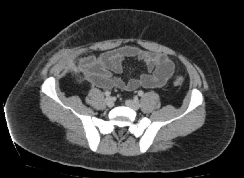 Colocutaneous fistula (Radiopaedia 56401-63062 A 67).jpg